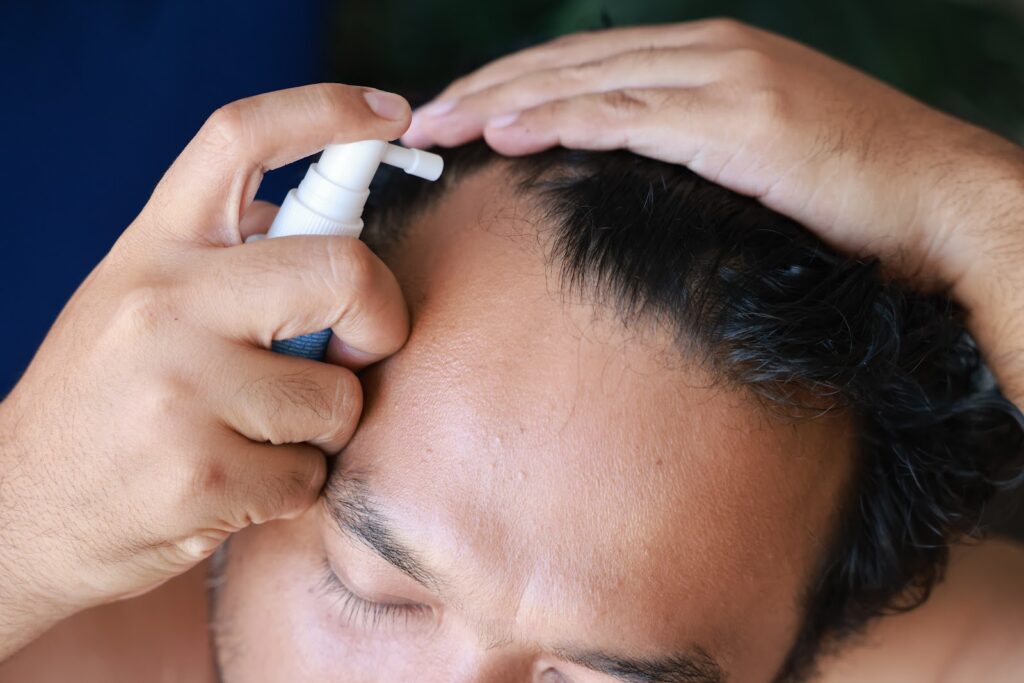 Minoxidil em spray: benefícios para um tratamento eficaz da perda de cabelo
